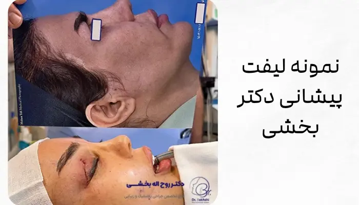 نمونه لیفت پیشانی دکتر بخشی نمونه لیفت پیشانی دکتر بخشی