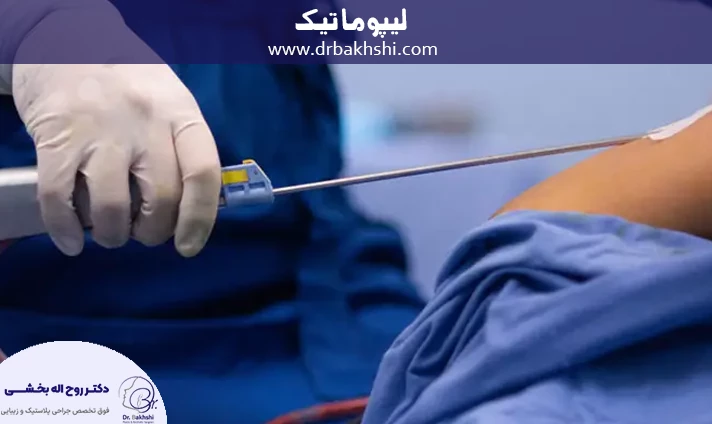 عمل لیپوماتیک