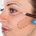 عوارض جراحی لیفت صورت