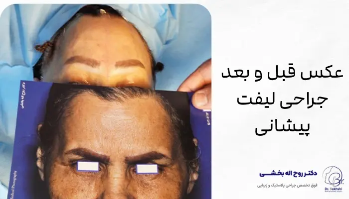 عکس قبل و بعد جراحی لیفت پیشانی عکس قبل و بعد جراحی لیفت پیشانی