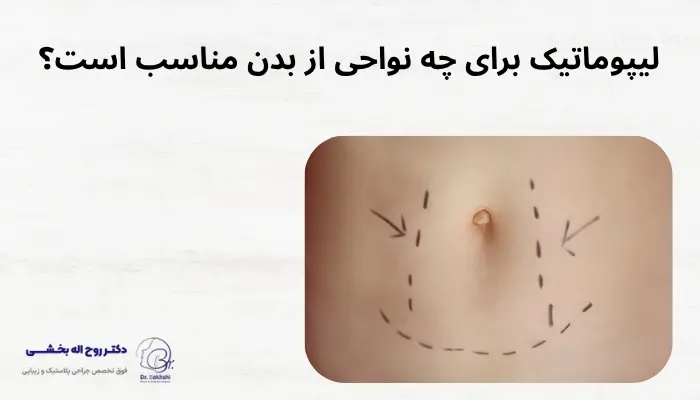 لیپوماتیک برای چه نواحی از بدن مناسب است؟ لیپوماتیک برای چه نواحی از بدن مناسب است؟