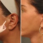 از بین بردن جای بخیه لیفت صورت