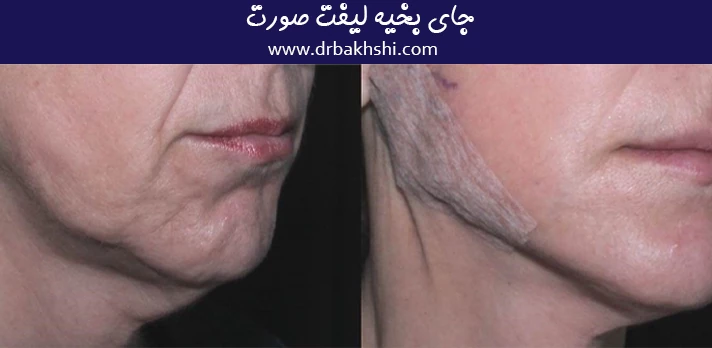 جای بخیه لیفت صورت