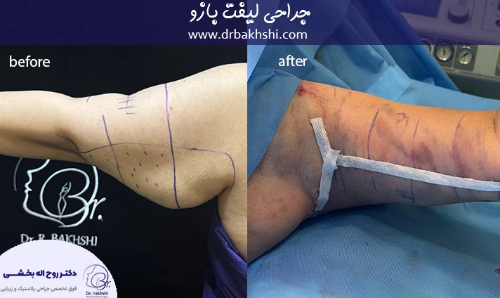 جراحی لیفت بازو