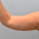 مزایای جراحی لیفت بازو