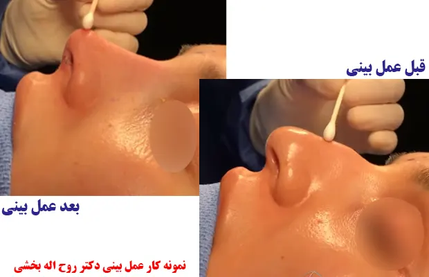 نمونه کار عمل بینی روح اله بخشی