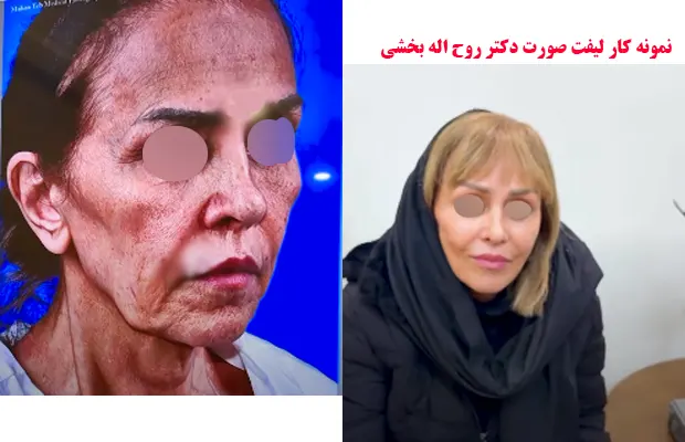 نمونه کار لیفت صورت دکتر روح اله بخشی