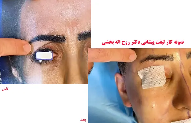 نمونه کار لیفت پیشانی دکتر بخشی