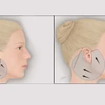 هزینه جراحی مینی لیفت صورت