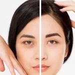 هزینه عمل لیفت پیشانی