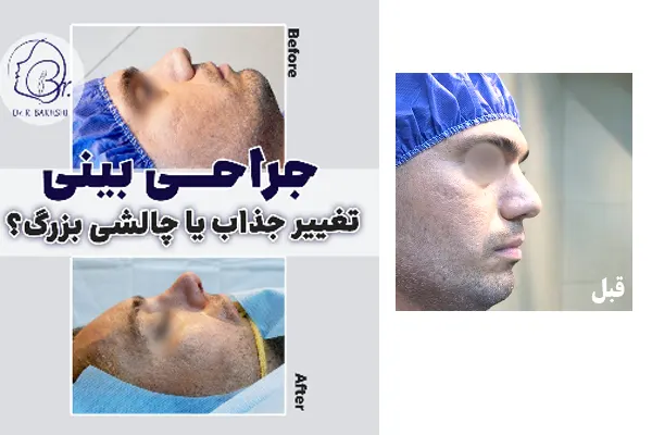 جراحی بینی گوشتی مردانه