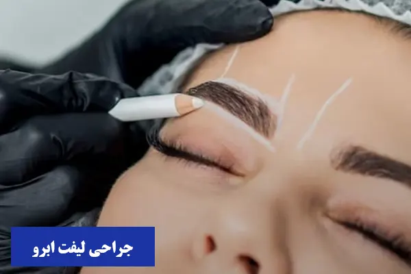 جراحی لیفت ابرو