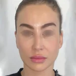 جراحی لیفت ابرو