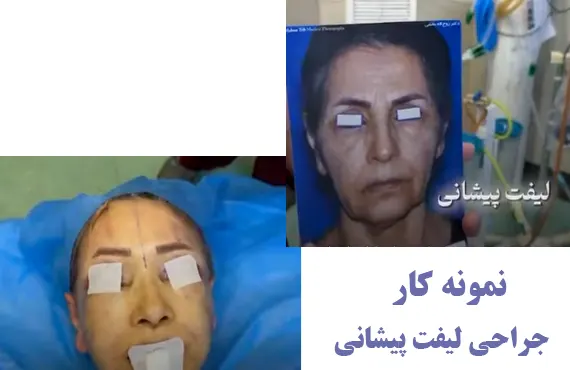 نمونه کار جراحی لیفت پیشانی