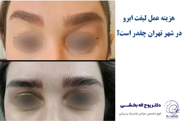هزینه عمل لیفت ابرو