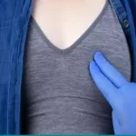 ورم سینه بعد از ماموپلاستی افزایشی