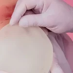 جراحی لیفت سینه و پروتز سینه همزمان