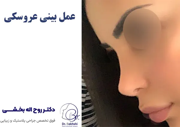 جراحی بینی عروسکی