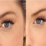 جراحی لیفت شقیقه