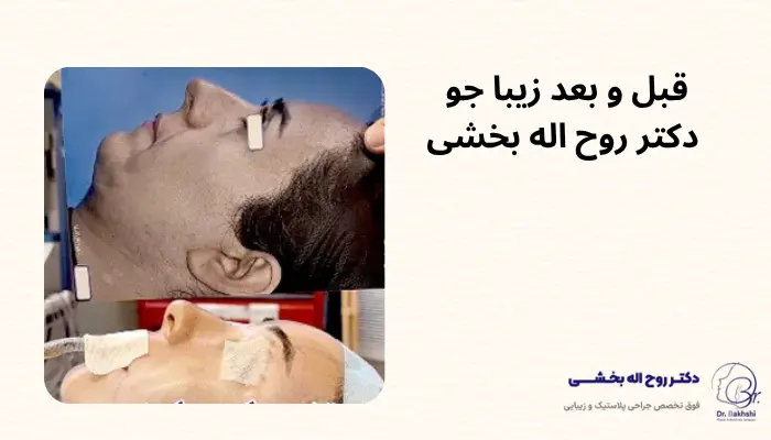 عکس قبل و بعد جراحی زیبایی توسط دکتر بخشی عکس قبل و بعد جراحی زیبایی توسط دکتر بخشی