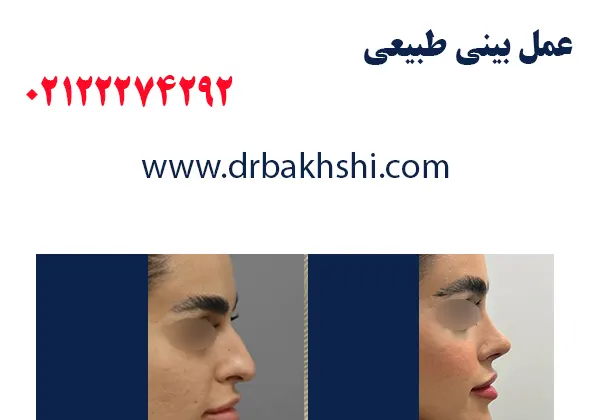 عمل بینی طبیعی