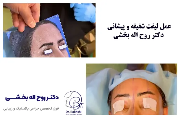 عمل لیفت شقیقه و پیشانی