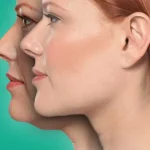 عمل لیفت غبغب