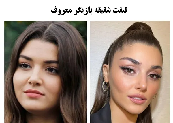 لیفت شقیقه بازیگر معروف