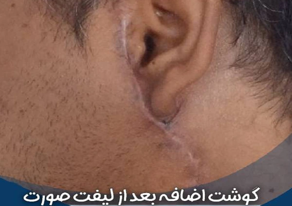 گوشت اضافه بعد از لیفت صورت