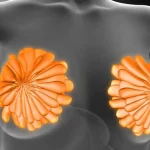 عمل پروتز سینه