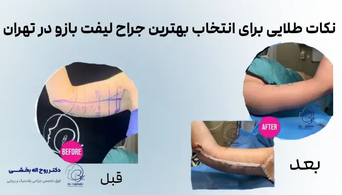 نکات طلایی برای انتخاب بهترین جراح لیفت بازو در تهران 
