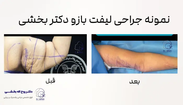 چرا دکتر روح‌اله بخشی بهترین جراح برای لیفت بازو در تهران است؟