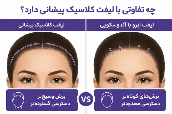 مقایسه محل برش در لیفت کلاسیک و آندوسکوپیک